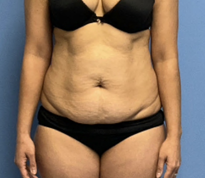 Tummy-Tuck-With-Liposuction--Case-Study-5652 | Before Liposuction